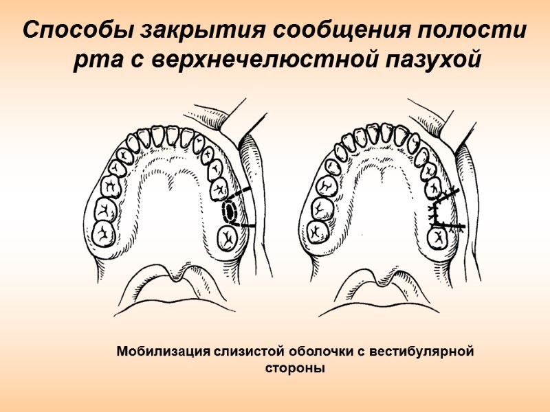 Способы закрытия сообщения полости  рта с верхнечелюстной пазухой Мобилизация слизистой оболочки с вестибулярной
